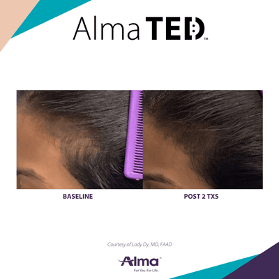 Hair restoration from the Alma Ted hair restoration device