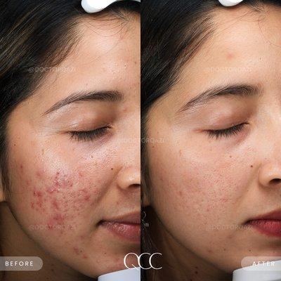 Active Acne Combination Treatment Results by Dr. Qazi!