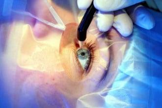 Lasik Surgery