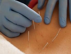 Dry Needling