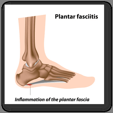 Ask about ASTYM treament, which works wonders on plantar fasciitis.