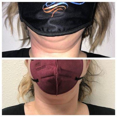 Neck slimming