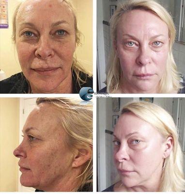 AMAZING Erbium Laser Resurfacing before and after