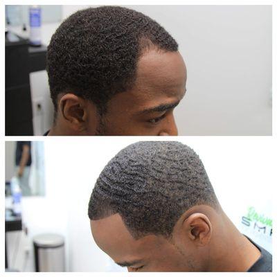 Before and after Scalp Micropigmentation hairline restoration