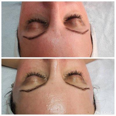 Look at those 11's disappear! Beautiful results from our DermaZen facial!