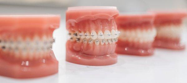 Esthetic ceramic braces