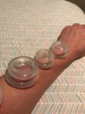 Cupping to increase circulation and free tense areas.