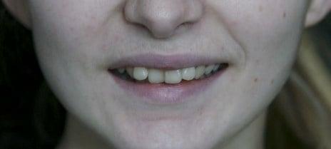 dentalveneers-Before