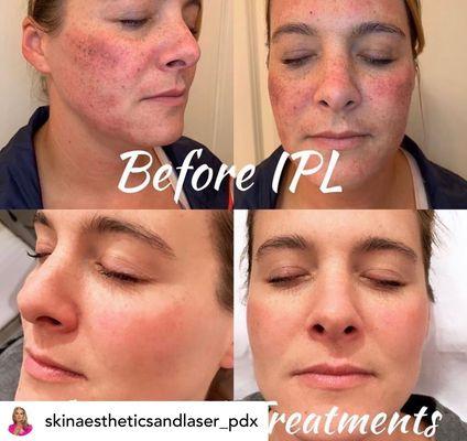 IPL photofacial