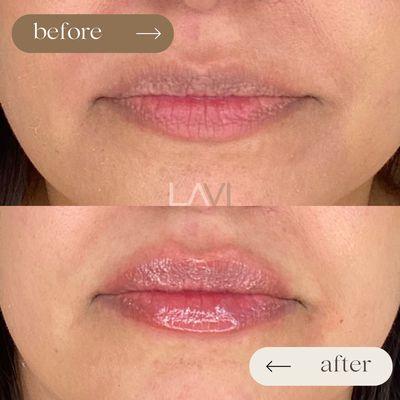 Subtle, natural enhancement with lip filler.