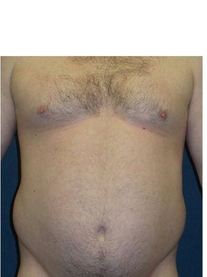 Male, Age 36 yr old BEFORE LIPOSUCTION ABDOMEN