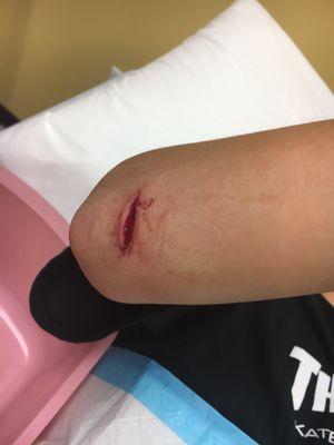 Elbow sliced while skateboarding! 11 year old boy