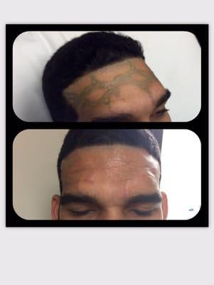 5 previous treatments from another clinic with no results but scarring.  1 treatment with Jason Moran.