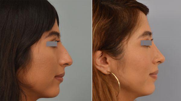 One and a half years after closed rhinoplasty by Dr. Grigoryants.  Most swelling has resolved.