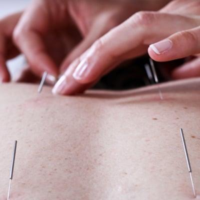 Hair-thin, sterile, disposable needles are gently inserted into the body to restore health.