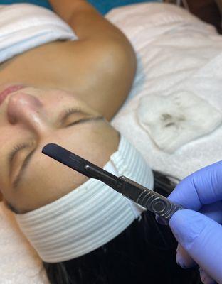 Dermaplaning is a manual exfoliating technique performed to remove the outermost layer of skin creating dewy, glowing skin.