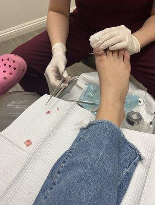 Toe nail removal