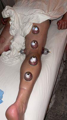 Cupping therapy,