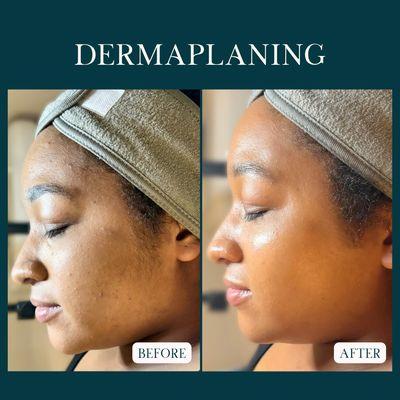 Dermaplaning with a Summer Breeze Signature Facial. Fully customized treatment including a Dermaplaning add-on.