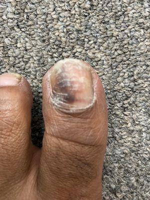 My infected toe