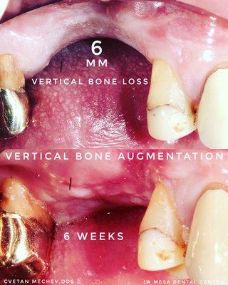 6 weeks healing after vertical bone ridge augmentation