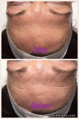 CooLifting treatment immediately after