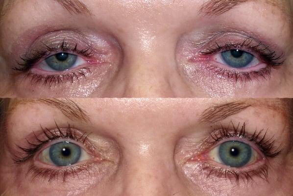 Before and After Upper eyelid ptosis (droopy eyelid surgery)
 www.DrMarkBrown.com 
 Mobile, AL 36609
 251-650-5437