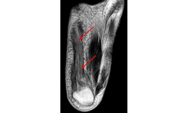 Baxter's Entrapment MRI