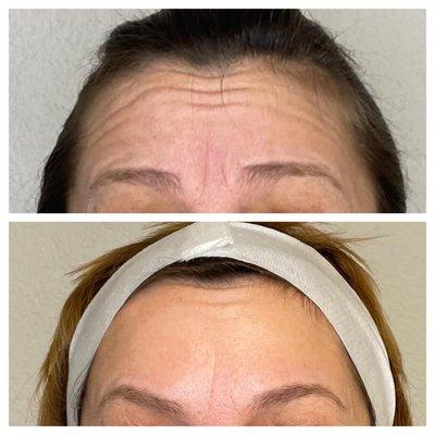 Juniper Aesthetics Client Before and After Treatment