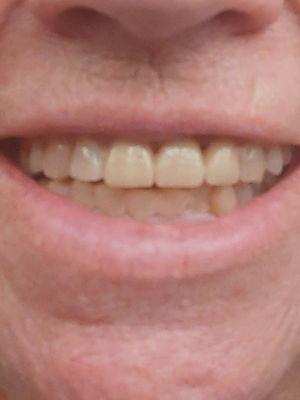 Upper front teeth have no gap & bridge very natural. Would you have guessed?