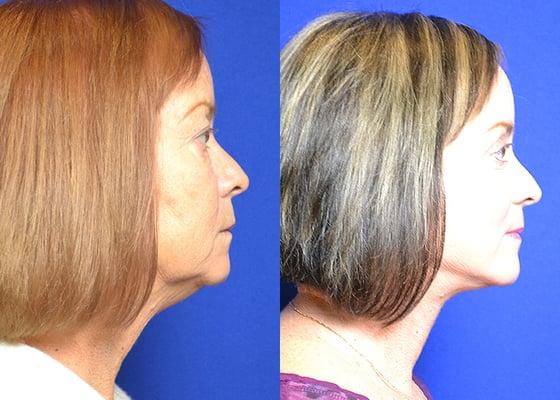 Facelift Procedure - Before & After.