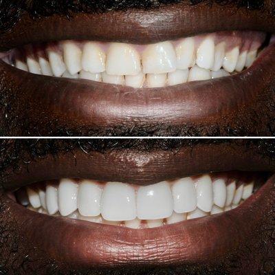 8 upper Porcelain Veneers