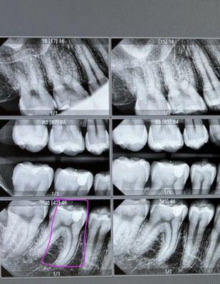 After she filled my teeth. I took this X-ray by another doctor.