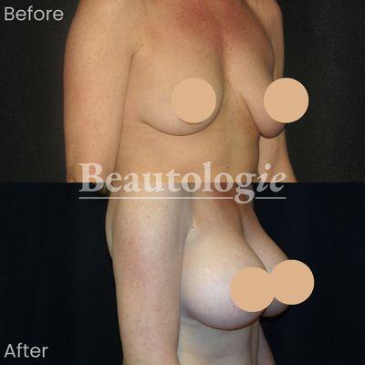 Bilateral Breast Augmentation with 500ml Right and 475ml Left Saline Implants Before and After by Dr. James Knoetgen