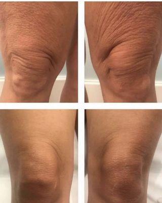 Morpheus8 body skin tightening