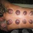 Cupping