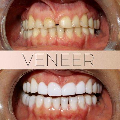 Veneer