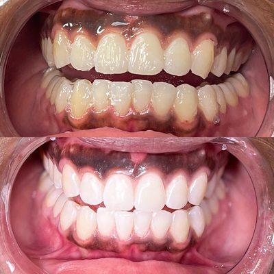 45 minute Teeth Whitening