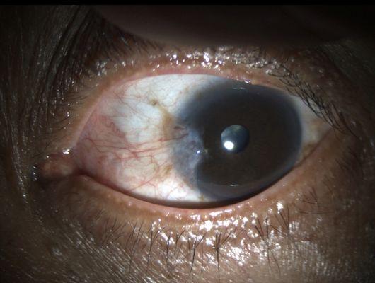 Pterygium before surgery