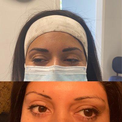 Microblading