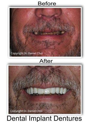 Before and After Dental Implant Dentures