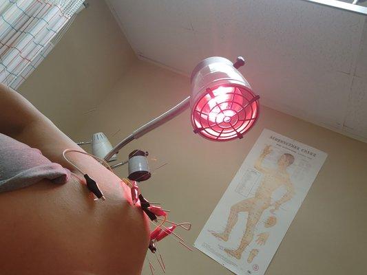 Acupuncture, some electrical stimulation & Heat