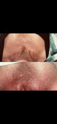 VI body peel to help lighten discoloration of chest due to sun damage.