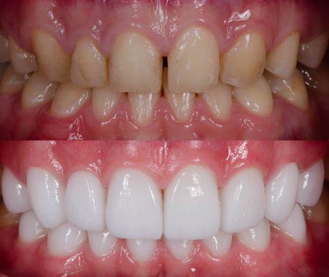 Cosmetic crowns before and after