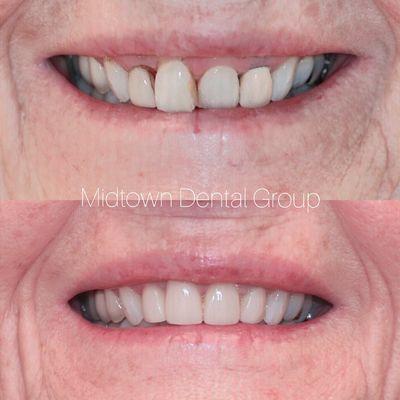 It's incredible how teeth whitening and 4 veneers can make such a difference.  -Dr Michael Bruno DDS