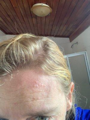 Cluster of bed bug bites on my forehead