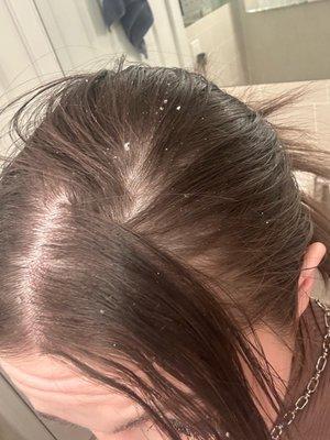 scalp flaking from Keratin treatment