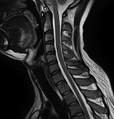 MRI scan of the Cervical Spine