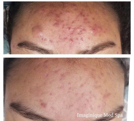 Pre & Post Acne Therapy