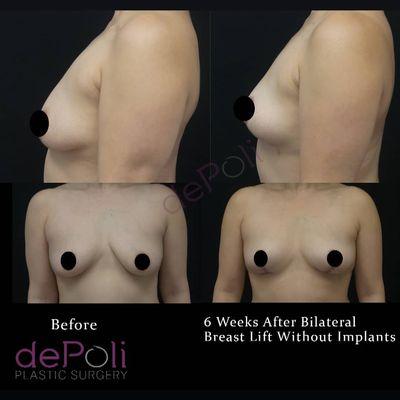 Bilateral breast lift